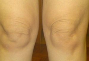 tighten loose skin over knees