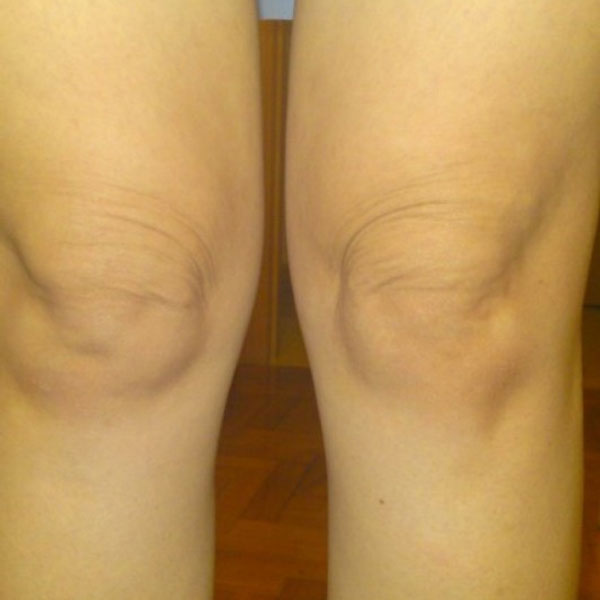 5_tips_to_tighten_loose_skin_over_knees_zcfyf.jpg