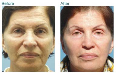 anti aging treatment result