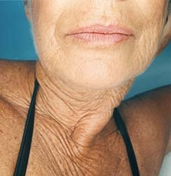antioxidant could offer miracle cure for wrinkles