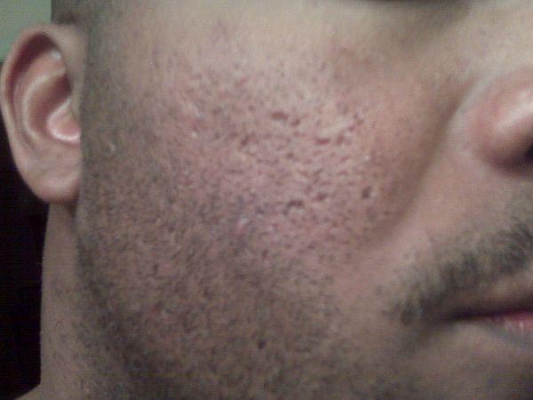 black skin acne