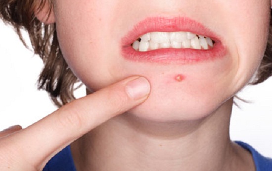 common acne treating mistakes