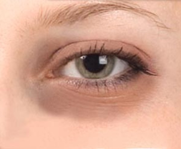 Dark circles under eyes