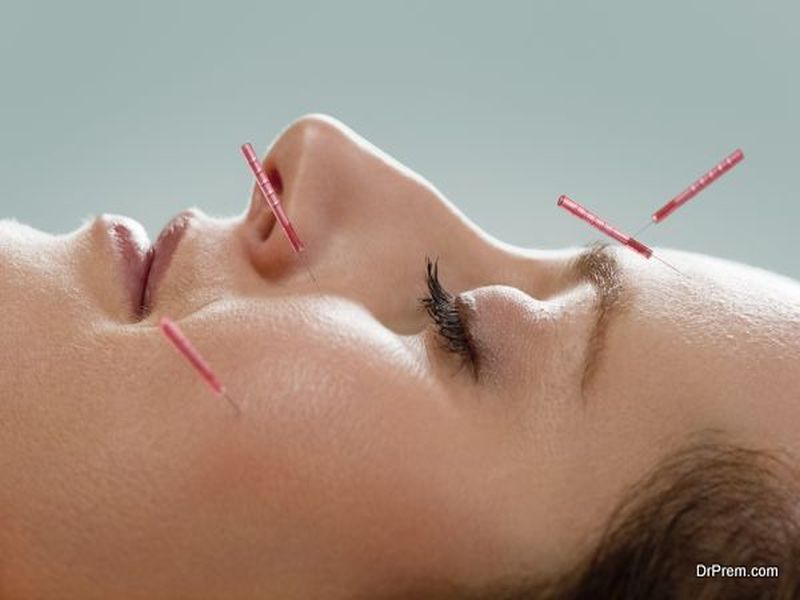 Acupuncture 