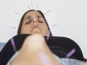 Acupuncture