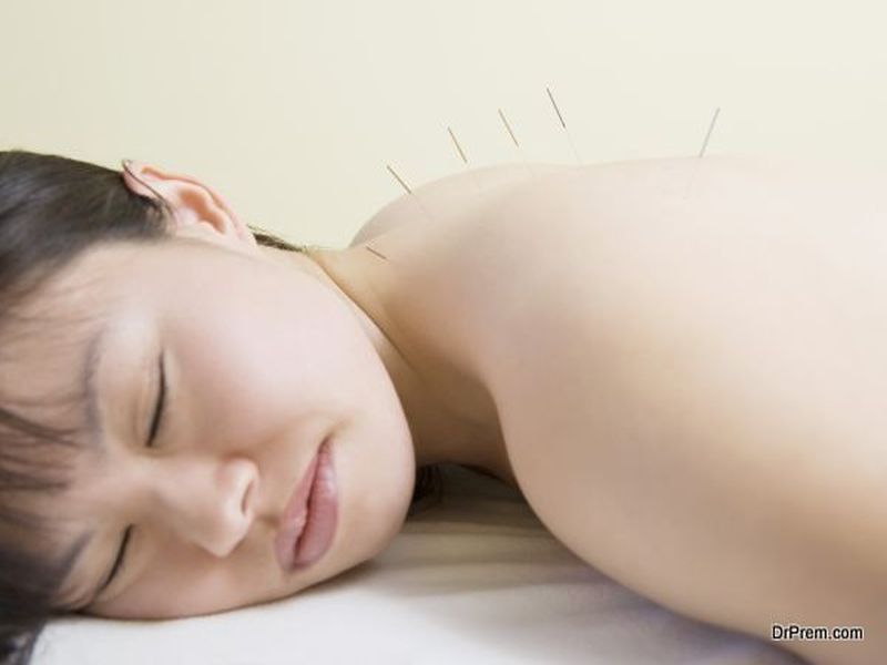 Acupuncture 