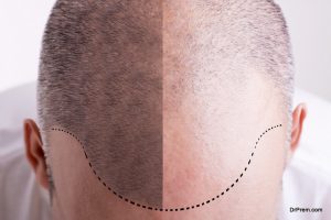 Hair-Restoration