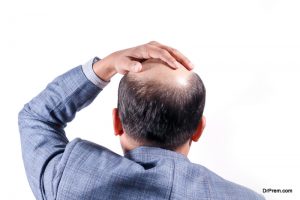 hair-loss