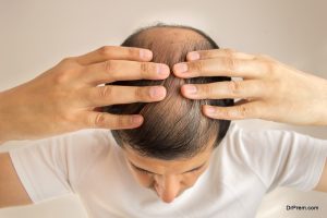 hair-loss