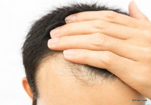 hair-loss