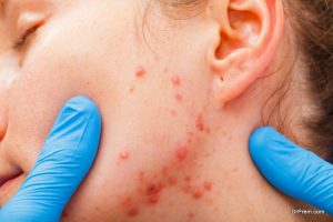 Fights Skin Infections