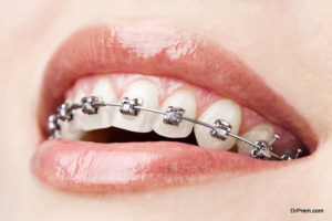 Fixed metal braces