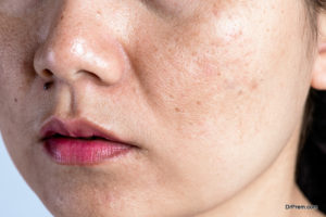 Hyperpigmentation