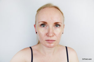 Hyperpigmentation