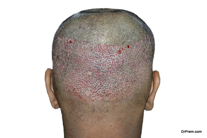 Hair Transplant Surgery