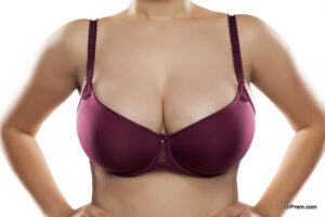 breast asymmetry corrected with an augmentation