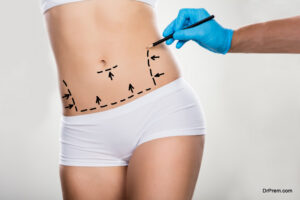 Liposuction