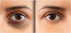 What Is the Best Under Eye Cream for Dark Circles